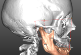 III classe scheletrica - cefalometria 3D programmata